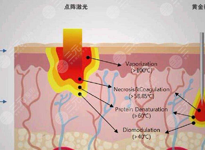 做完点阵激光需要注意哪些问题呢?
