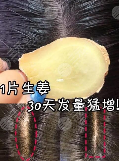 擦生姜可以生发吗