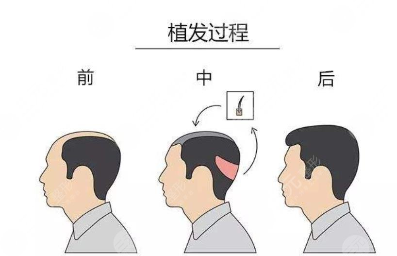 种植头发
