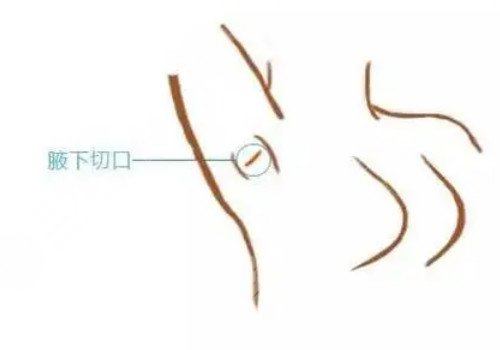 隆胸腋下切口的优势和缺点有哪些？
