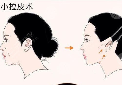 小切口提拉能保持几年？