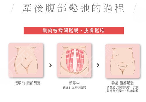 腹部拉皮手术费多少钱？