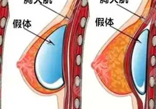 毛面假体隆胸多久变软？
