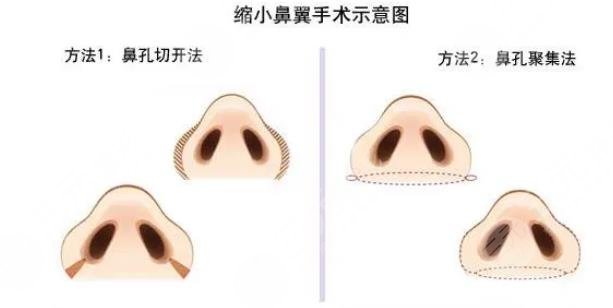 鼻翼缩小好不好