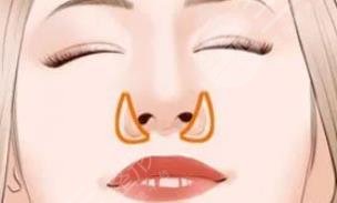 鼻翼缩小好不好