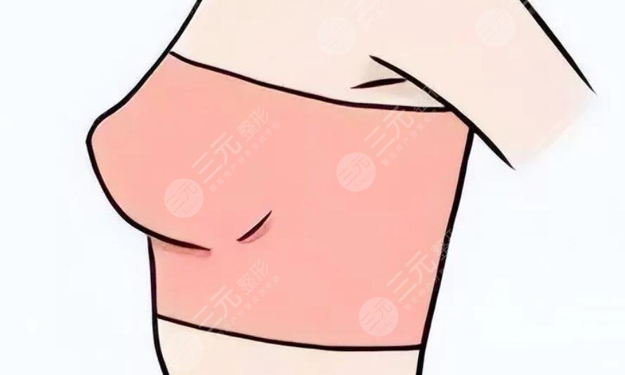 乳房双环悬吊