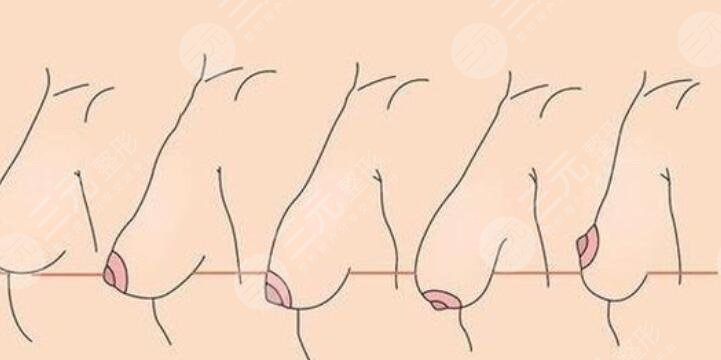乳房双环悬吊