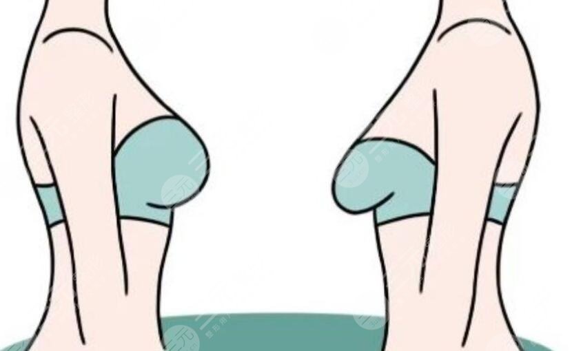 乳房双环悬吊