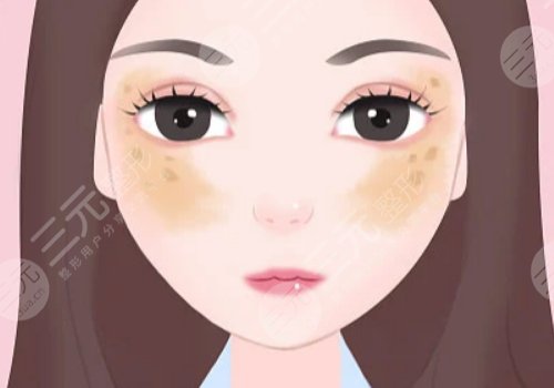 激光祛斑的危害与效果揭秘
