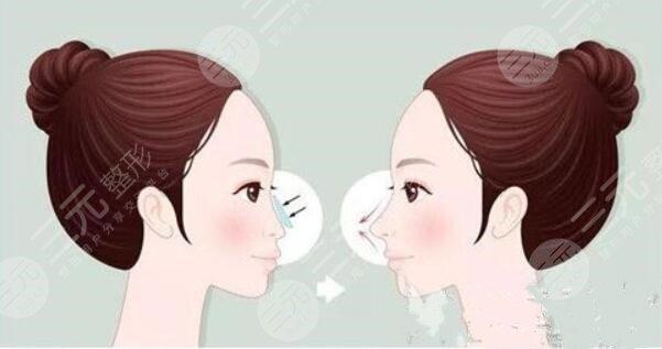 做了肋软骨和耳软骨之后需要注意什么?