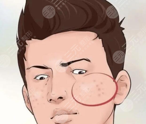 男生去痘印选哪种护肤品好?