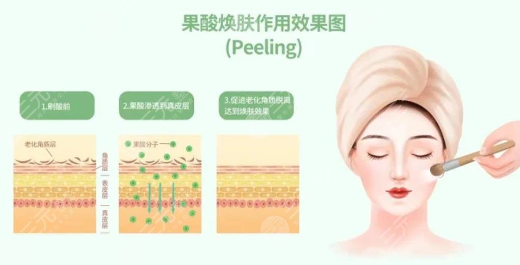 果酸换肤