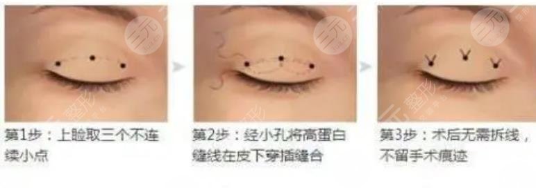埋线双眼皮