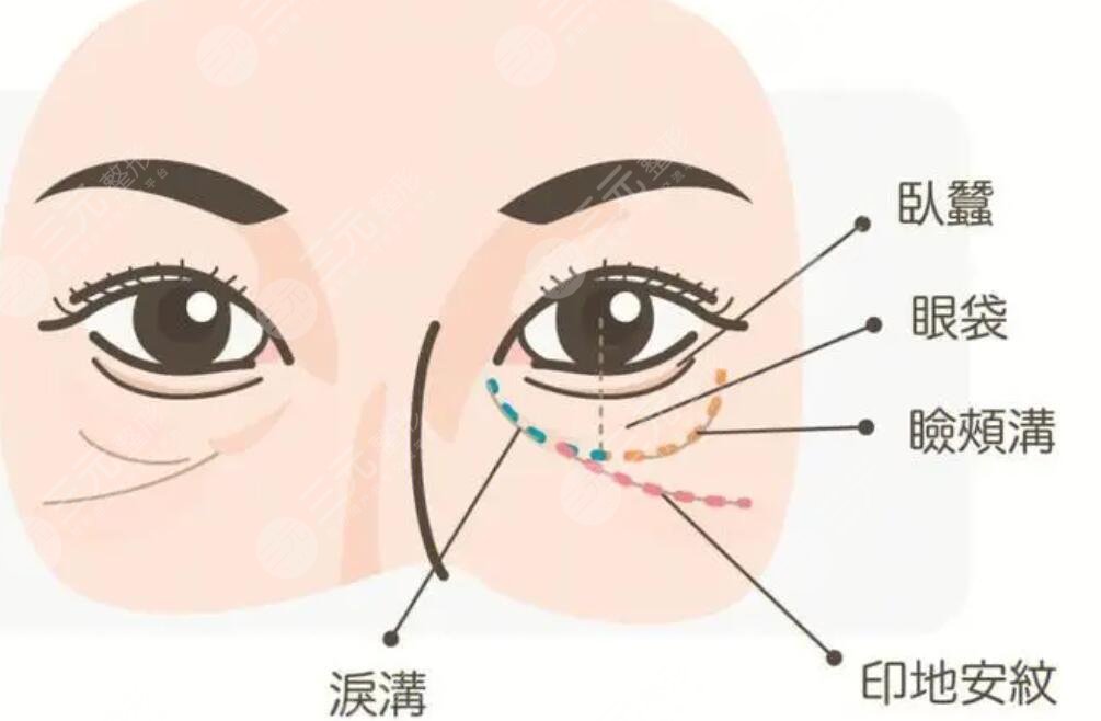 眼凹陷