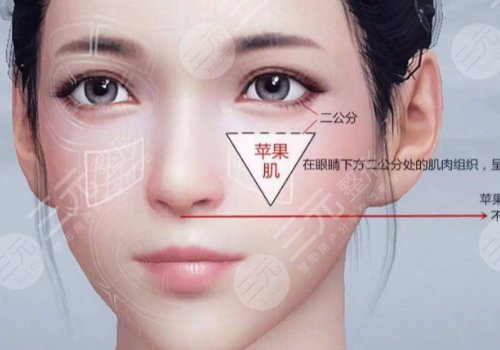 悦升线提升苹果肌能保持多久？