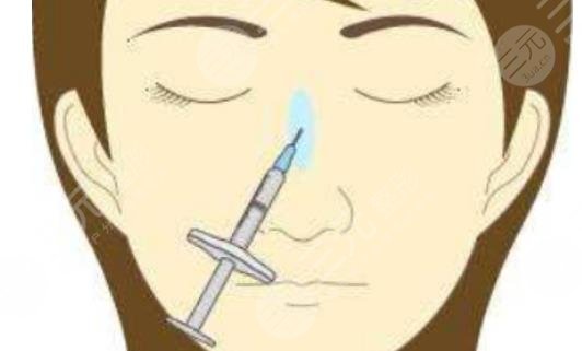 注射隆鼻
