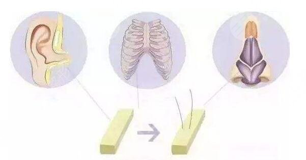 做自体软骨鼻需要多少钱?