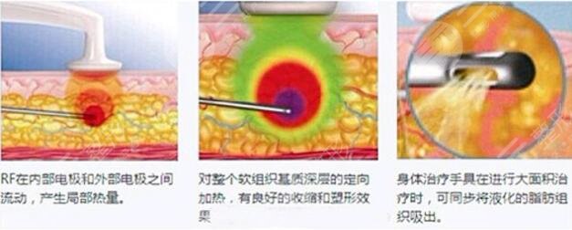 光纤溶脂优势：