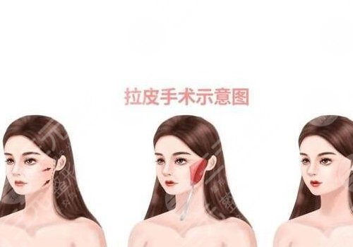 小拉皮适合多大年龄做？