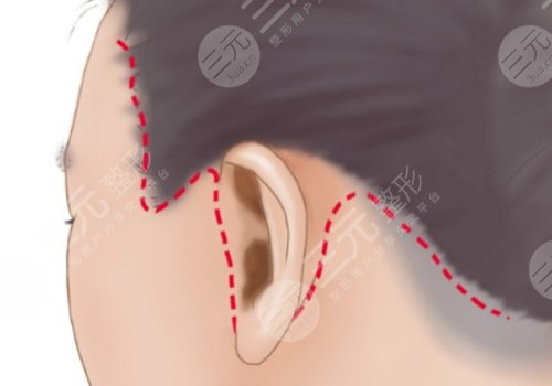 大拉皮手术大概多少钱？