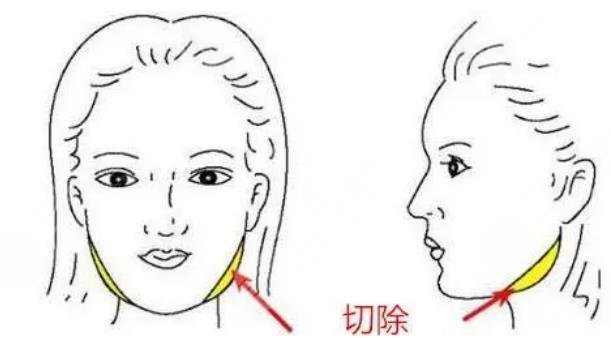 消除下颌角手术风险大吗