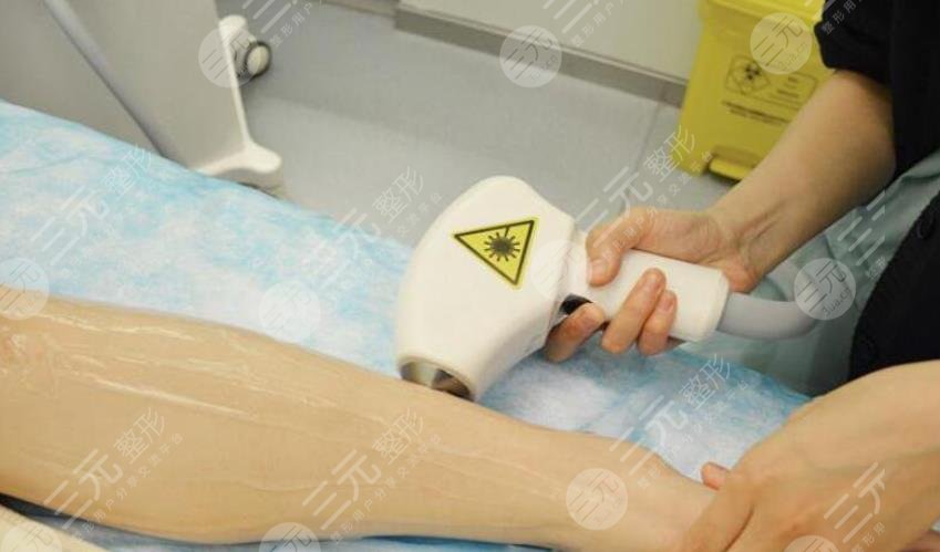 小腿激光脱毛的价格是多少