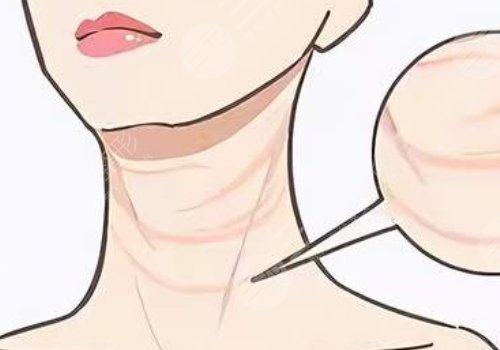 颈纹深的爱美人士应该怎么改善呢?