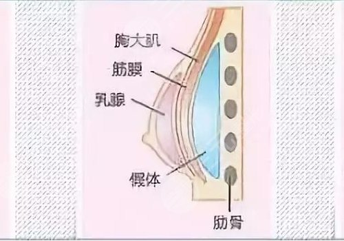 傲诺拉隆胸假体多少钱？