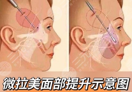 做薇拉美的线多长时间能吸收完？