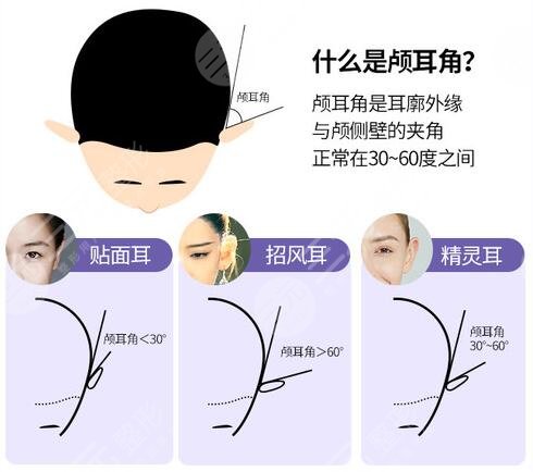 耳基底提升