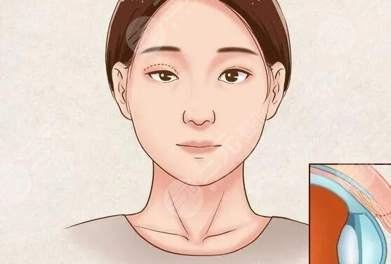 做双眼皮的后遗症老了有哪些？多少钱|护理注意事项
