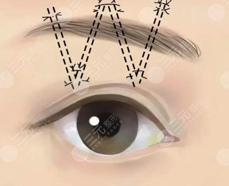 做双眼皮的后遗症老了有哪些?