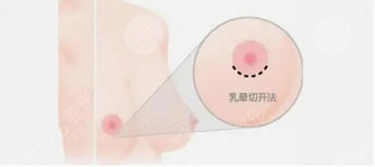 假体隆胸