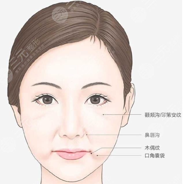 口角囊袋