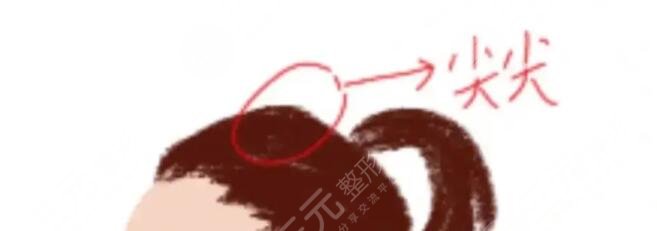抬高颅顶