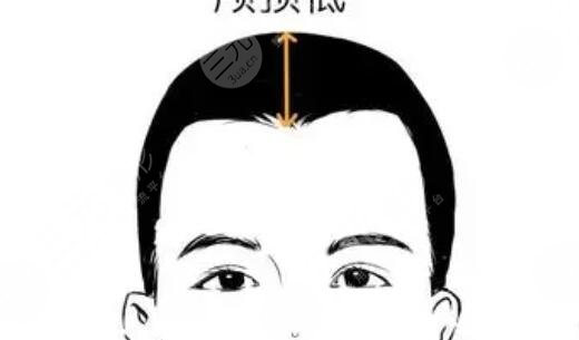 抬高颅顶