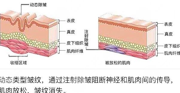 除皱