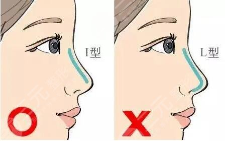 膨体隆鼻的缺点有哪些？多少钱|怎么护理？
