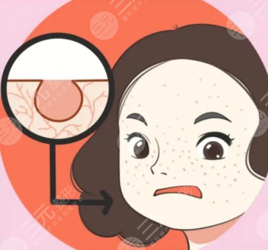 怎样收缩脸部毛孔粗大的方法，光子嫩肤是好的项目选择！