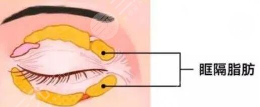 下眼凹陷