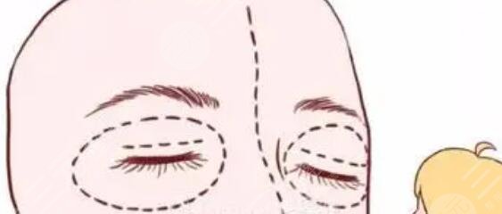 眼凹陷脂肪填充