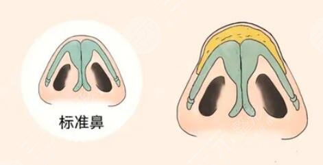 鼻翼缩小手术后遗症会有吗？价格是多少？恢复期是多久？