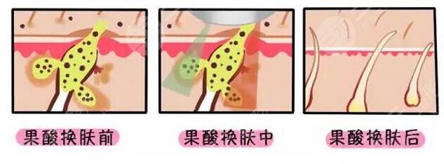 果酸换肤好不好怎么看?