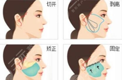 脸部提升拉皮贵不贵?