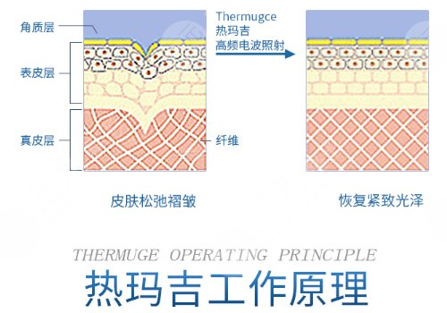 热玛吉的功效作用及副作用有哪些？