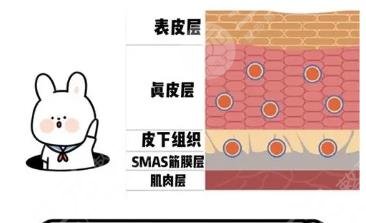 筋膜提升