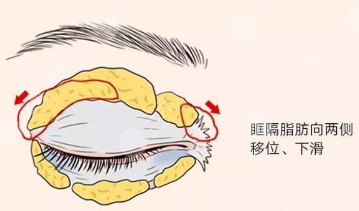 眼周凹陷填充
