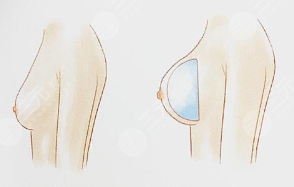 浪漫情怀假体隆胸之后影响哺乳吗？