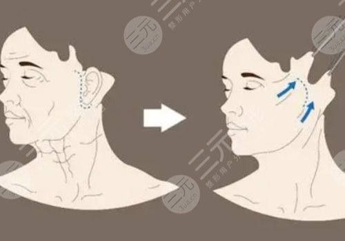 拉皮的副作用和危害大吗?