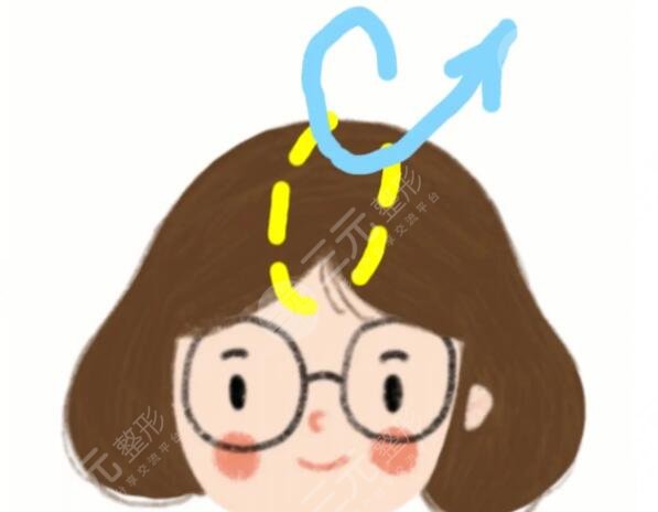 颅顶增高
